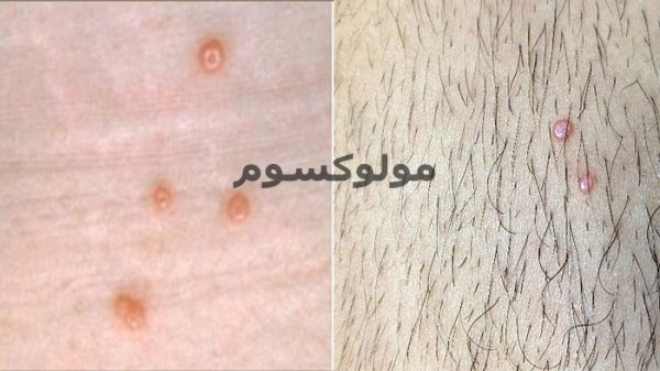 عکس جوش سر سفید در ناحیه تناسلی زنان