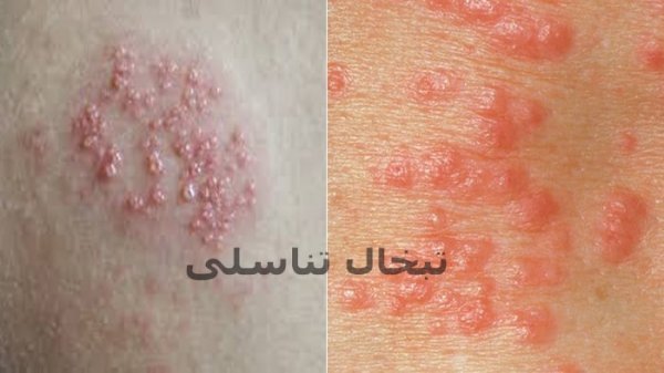 عکس جوش سر سفید در ناحیه تناسلی زنان