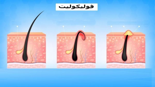 عکس جوش سر سفید در ناحیه تناسلی زنان
