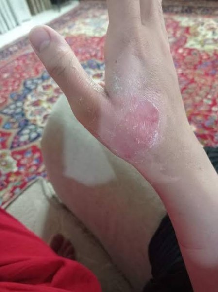  عکس دسته سوخته