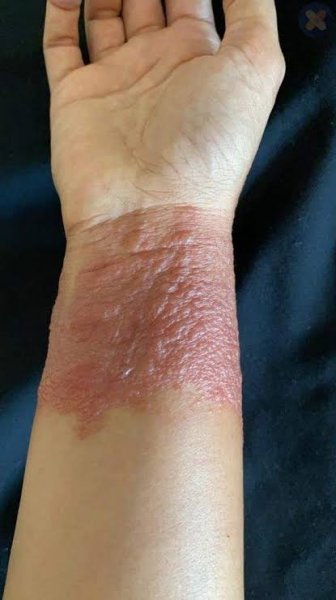  عکس دسته سوخته